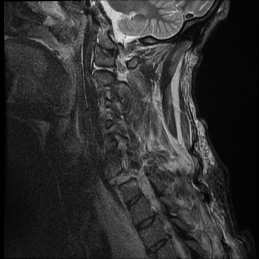 File:Bilateral perched facets with cord injury (Radiopaedia 45587-49714 Sagittal STIR 4).jpg