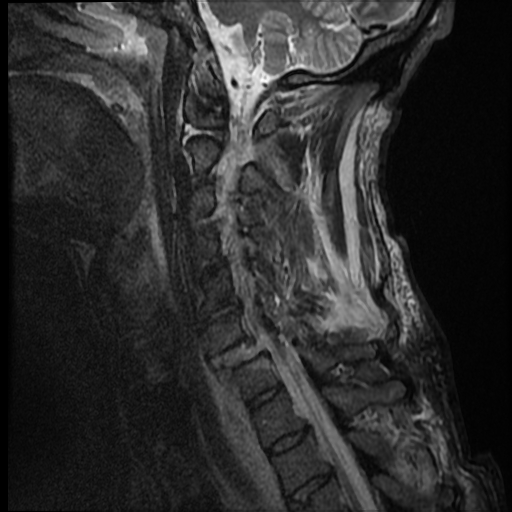 File:Bilateral perched facets with cord injury (Radiopaedia 45587-49714 Sagittal STIR 5).jpg