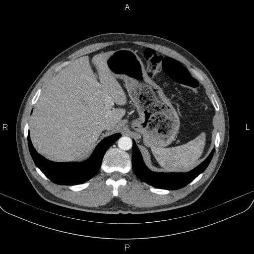 Bilateral pulmonary AVM (Radiopaedia 83134-97505 A 69).jpg