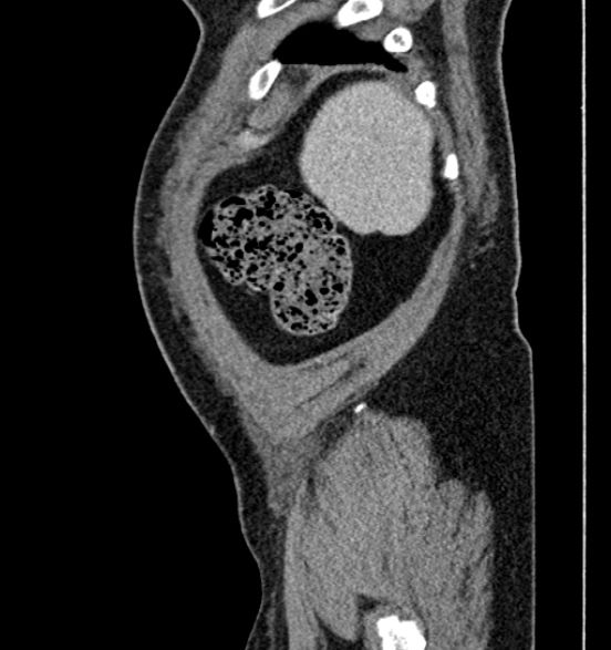 Bilateral rectus sheath hematomas (Radiopaedia 50778-56252 B 10).jpg