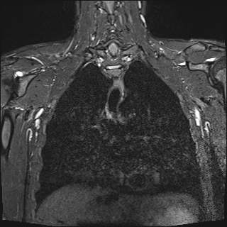 File:Bilateral spinoglenoid notch ganglion cysts (Radiopaedia 29577-30082 Coronal STIR 16).jpg