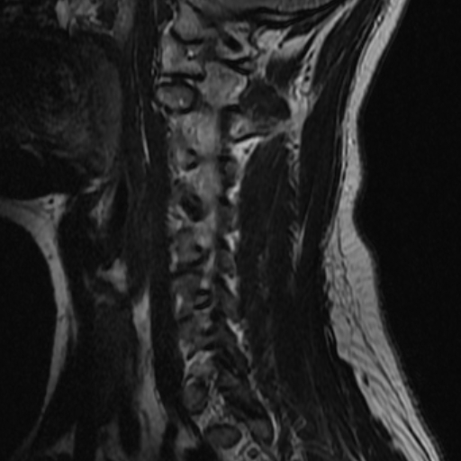 File:Bilateral tortuous vertebral arteries (Radiopaedia 19070-19039 Sagittal T2 3).jpg