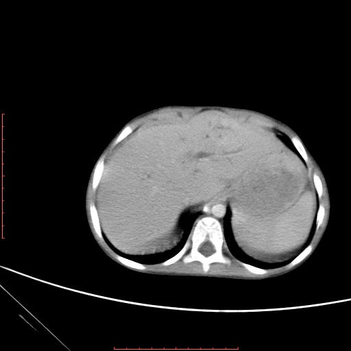 Biliary tract embryonal rhabdomyosarcoma (Radiopaedia 51815-57648 A 7).jpg