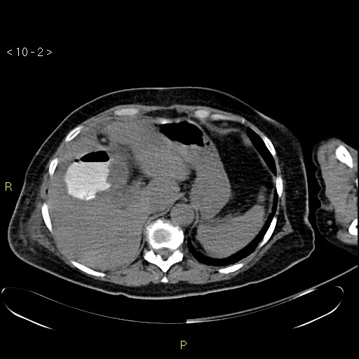 File:Biloma with drainage into the colon (Radiopaedia 20032-20068 B 2).jpg