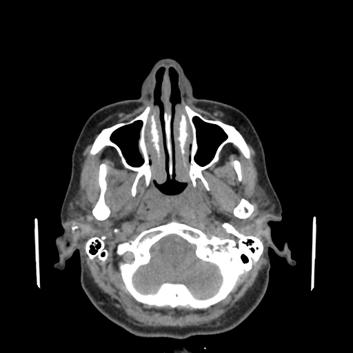 Bisphosphonate-related osteonecrosis of the jaw (Radiopaedia 71324-81642 non-contrast 134).jpg