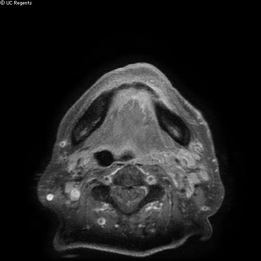Bisphosphonate-related osteonecrosis of the maxilla (Radiopaedia 51367-57101 Axial T1 C+ fat sat 4).jpg