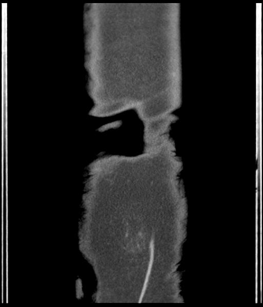 Bladder rupture post renal biopsy (Radiopaedia 30863-31572 Coronal non-contrast 56).jpg