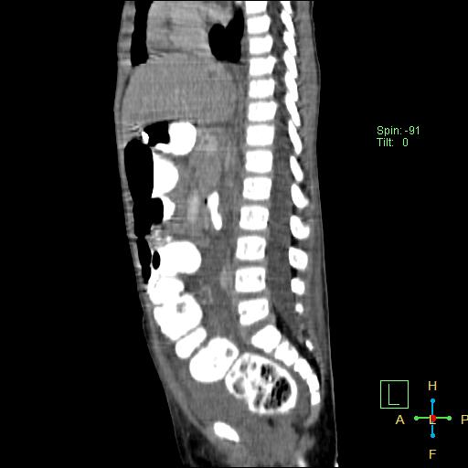 File:Blunt abdominal trauma (Radiopaedia 24780-25044 D 18).jpg