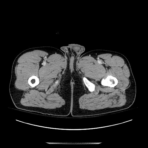 Blunt abdominal trauma with solid organ and musculoskelatal injury with active extravasation (Radiopaedia 68364-77895 A 177).jpg
