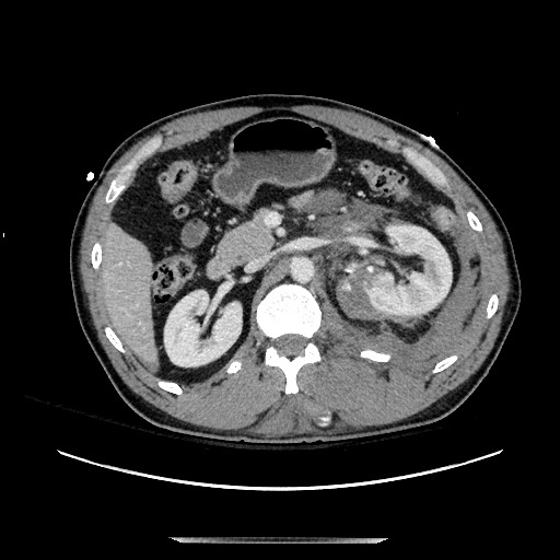 Blunt abdominal trauma with solid organ and musculoskelatal injury with active extravasation (Radiopaedia 68364-77895 A 53).jpg