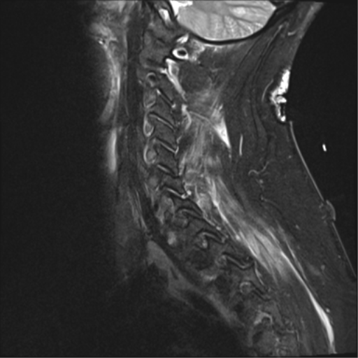 File:Blunt cerebrovascular injury (Radiopaedia 53682-59744 Sagittal T2 fat sat 2).png