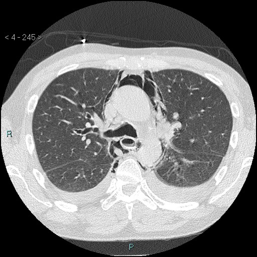 Boerhaave syndrome (Radiopaedia 27683-27897 lung window 6).jpg