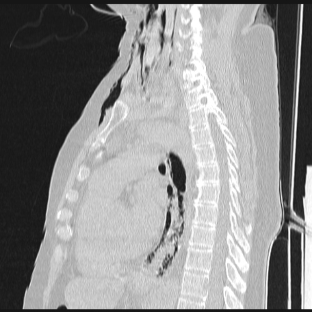 Boerhaave syndrome (Radiopaedia 45644-49799 Sagittal lung window 46).jpg