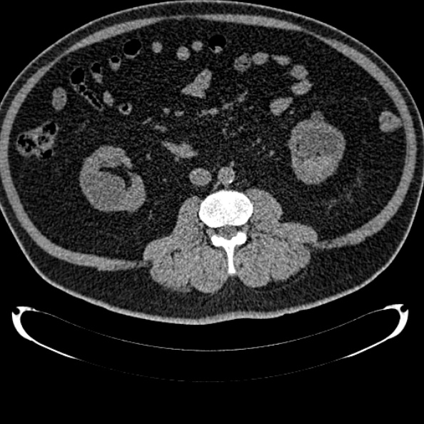 Bosniak renal cyst - type IV (Radiopaedia 24244-24518 Axial non-contrast 164).jpg