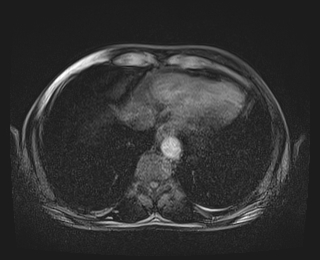 Bouveret syndrome (Radiopaedia 61017-68856 Axial T1 fat sat 4).jpg