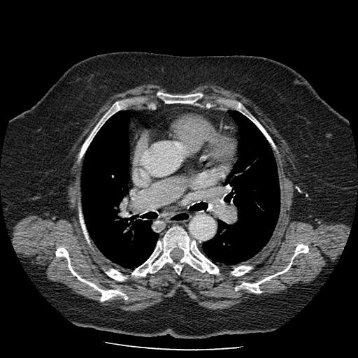 Bovine aortic arch - right internal mammary vein drains into the superior vena cava (Radiopaedia 63296-71875 A 67).jpg