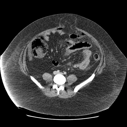 Bowel and splenic infarcts in acute lymphocytic leukemia (Radiopaedia 61055-68915 A 88).jpg