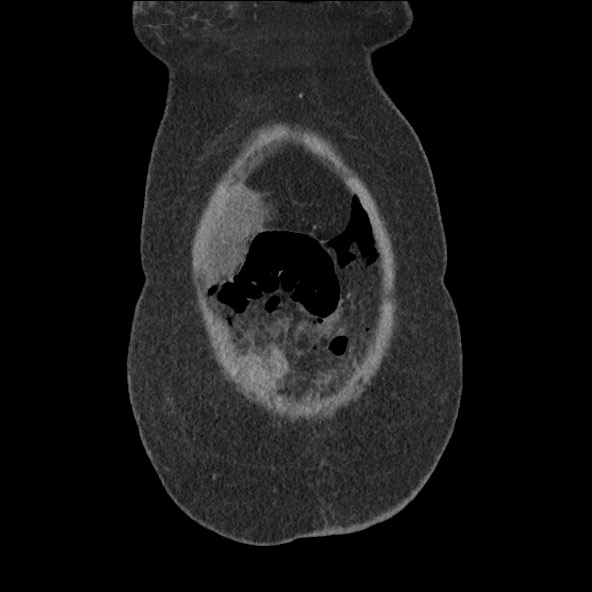 Bowel and splenic infarcts in acute lymphocytic leukemia (Radiopaedia 61055-68915 B 10).jpg