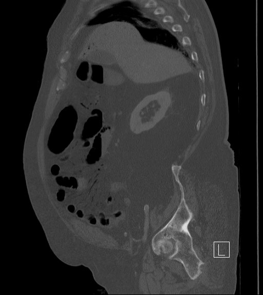 Bowel ischemia secondary to SMA occlusion with extensive portomesenteric venous gas (Radiopaedia 54656-60871 Sagittal bone window 81).jpg