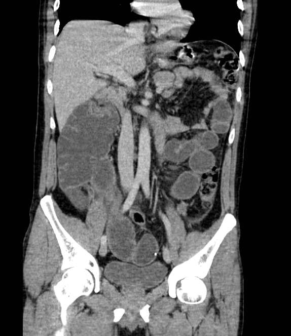 Bowel obstruction from colon carcinoma (Radiopaedia 22995-23028 C 36).jpg