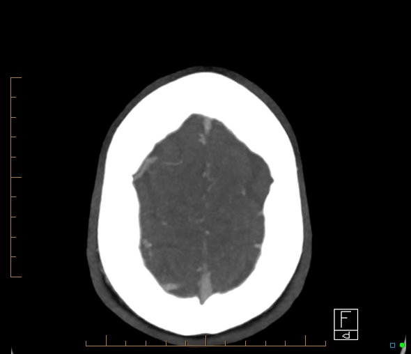 Brachiocephalic trunk stenosis (Radiopaedia 87242-103519 A 7).jpg