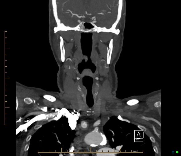 Brachiocephalic trunk stenosis (Radiopaedia 87242-103519 B 32).jpg