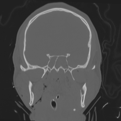 Brain contusions, internal carotid artery dissection and base of skull fracture (Radiopaedia 34089-35339 Coronal bone window 31).png