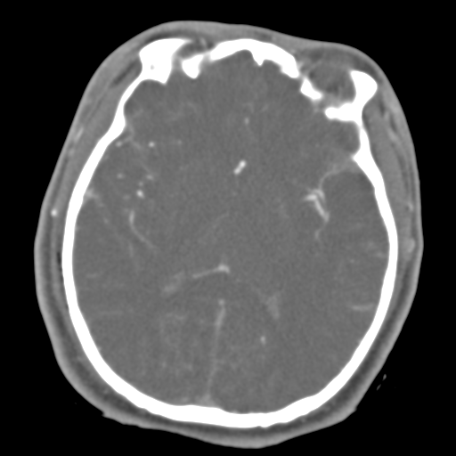 Brain contusions, internal carotid artery dissection and base of skull fracture (Radiopaedia 34089-35339 D 27).png