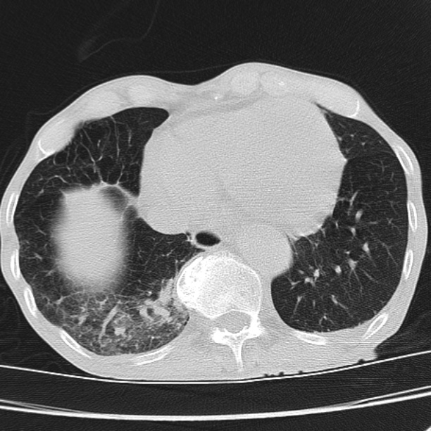 Brain metastases from lung cancer (Radiopaedia 27849-28093 Axial lung window 51).jpg