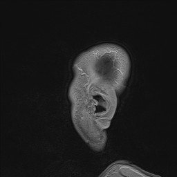 Brain metastasis (Radiopaedia 42617-45761 Sagittal T1 C+ 3).jpg