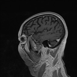 Brain metastasis (Radiopaedia 42617-45761 Sagittal T1 C+ 79).jpg