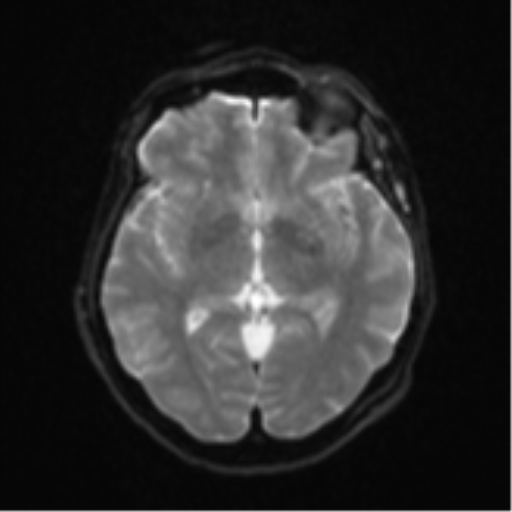 File:Brain metastasis (sarcoma) (Radiopaedia 47576-52209 Axial DWI 13).png