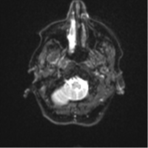 Brain metastasis (sarcoma) (Radiopaedia 47576-52209 Axial DWI 3).png