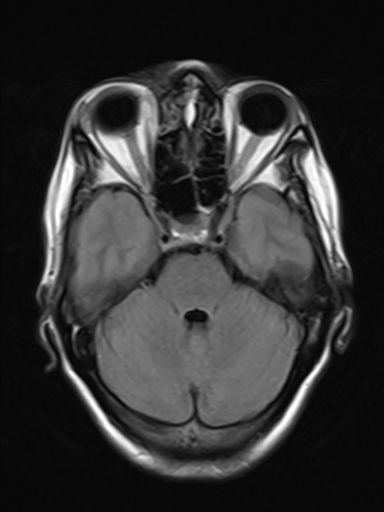 File:Brain metastasis as initial presentation of non-small cell lung cancer (Radiopaedia 65122-74126 Axial FLAIR 7).jpg