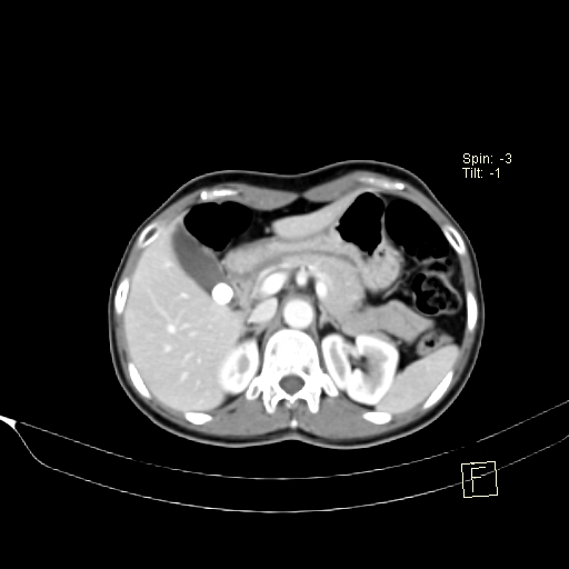 Brain metastasis as initial presentation of non-small cell lung cancer (Radiopaedia 65122-74127 A 52).jpg