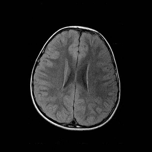File:Brainstem ganglioglioma (Radiopaedia 10763-11224 Axial FLAIR 7).jpg