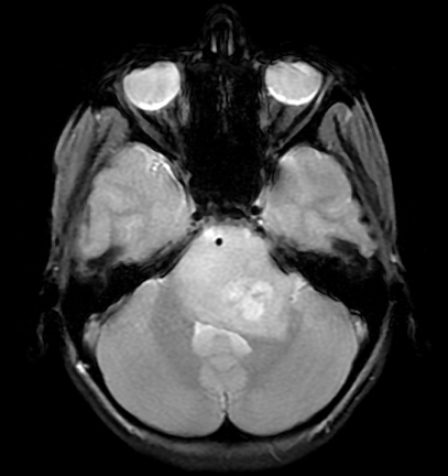 File:Brainstem glioma (Radiopaedia 9444-10124 Axial Gradient Echo 1).jpg