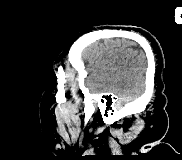 Brainstem hemorrhage (Radiopaedia 81294-94976 C 50).jpg