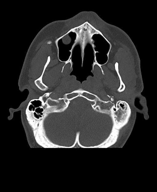 Branchial cleft cyst (Radiopaedia 31167-31875 Axial bone window 12).jpg