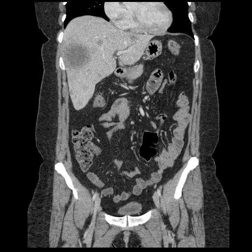 File:Breast cancer pseudocirrhosis after chemotherapy (Radiopaedia 65407-74456 Coronal 19).jpg