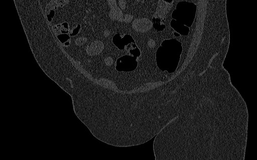 Breast carcinoma with pathological hip fracture (Radiopaedia 60314-67993 Coronal bone window 40).jpg