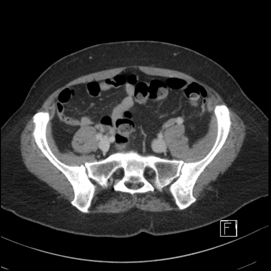File:Breast metastases from renal cell cancer (Radiopaedia 79220-92225 C 84).jpg