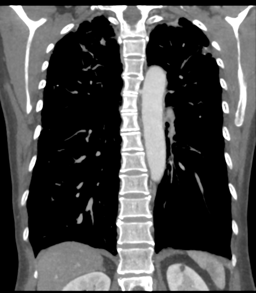 File:Bronchial artery aneurysms (Radiopaedia 42282-45385 Coronal C+ delayed 46).png