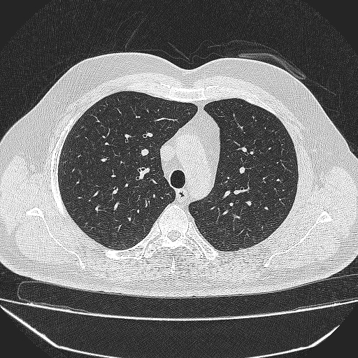 File:Bronchial atresia (Radiopaedia 58271-65417 Axial lung window 14).jpg