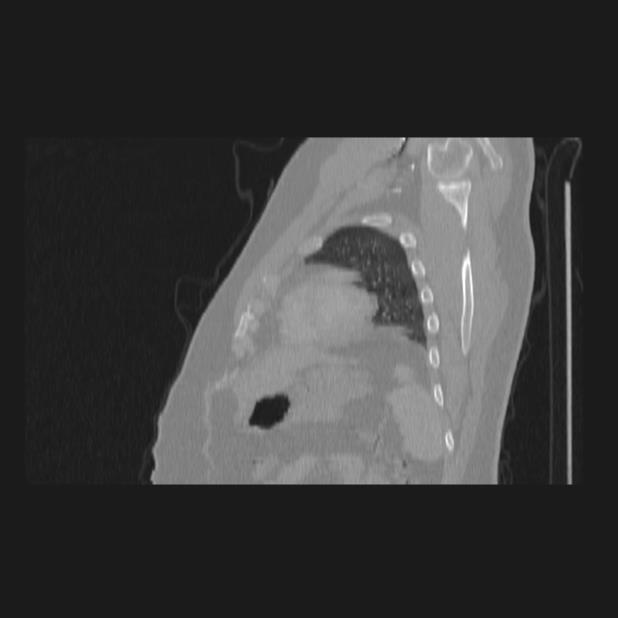Bronchial atresia (Radiopaedia 60685-68439 Sagittal lung window 79).jpg
