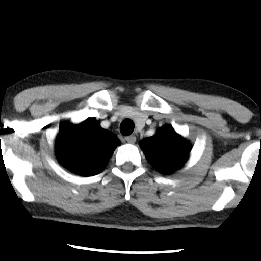 Bronchial carcinoid tumor (Radiopaedia 67377-76764 A 11).jpg