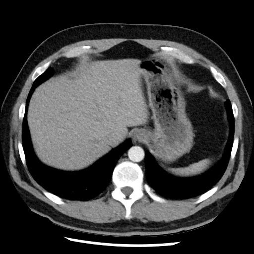 Bronchial carcinoid tumor (Radiopaedia 67377-76764 A 52).jpg