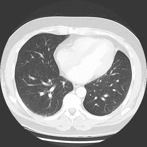 Bronchial carcinoid tumor (Radiopaedia 67377-76764 Axial lung window 41).jpg
