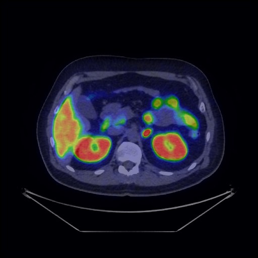 Bronchial carcinoid tumor (Radiopaedia 67377-76765 68Ga-DOTATATE PET-CT 46).jpg