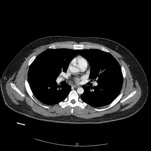 Bronchial carcinoid tumor (Radiopaedia 78272-90875 A 50).jpg